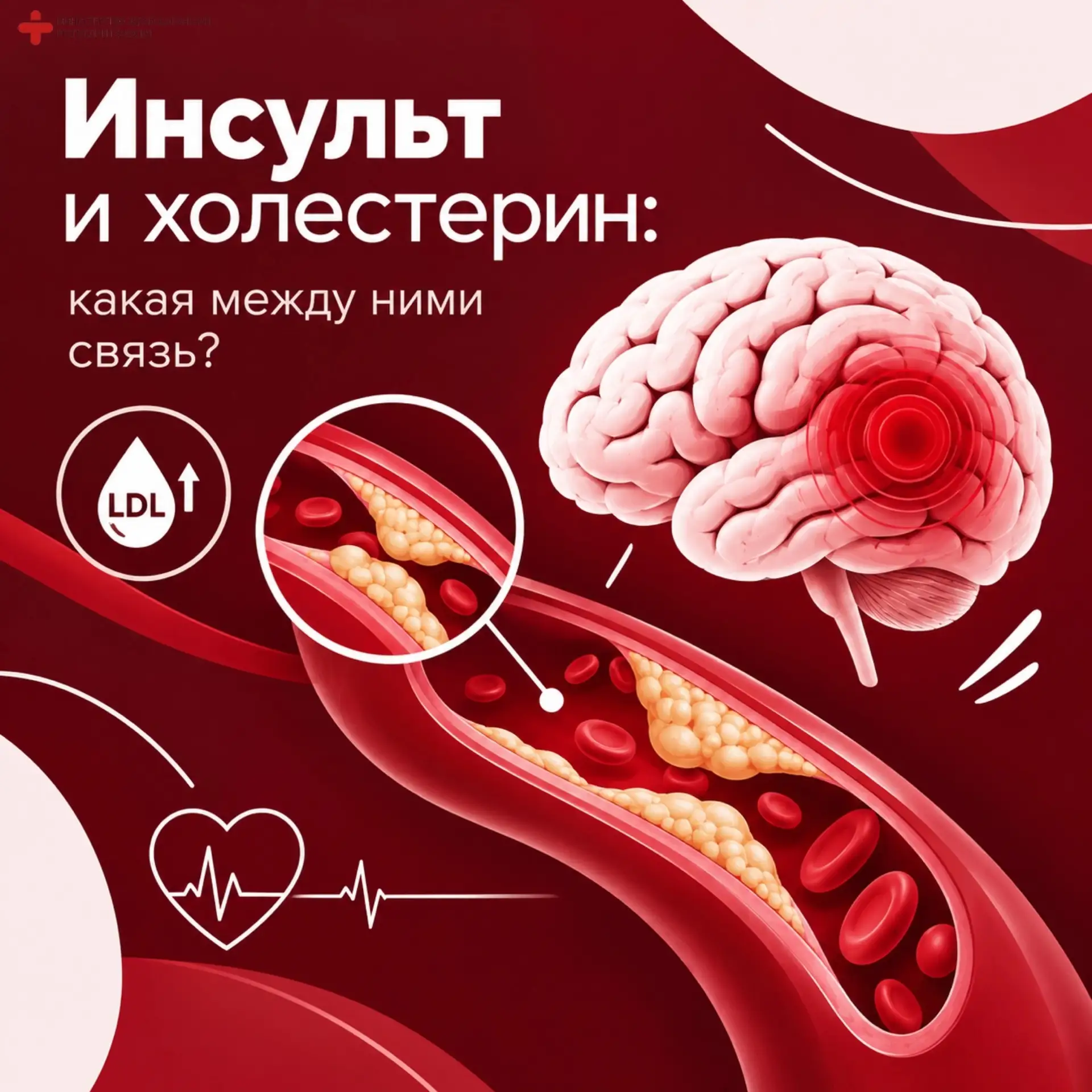 Инсульт и холестерин: какая между ними связь?